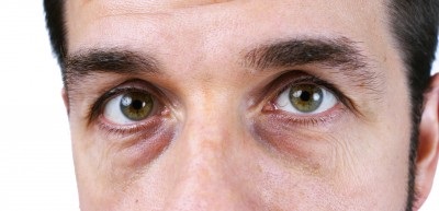 Bolsas debajo de ojos
