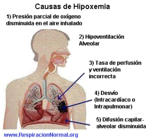 Causas de la hipoxemia