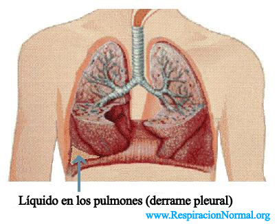 liquido en los pulmones
