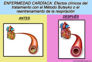 Reentrenamiento de la respiración y el método Buteyko para la cardiopatía isquémica